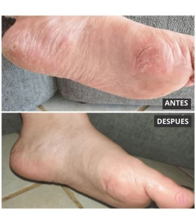 Même Calcetines hidratantes tratamiento pies quimioterapia