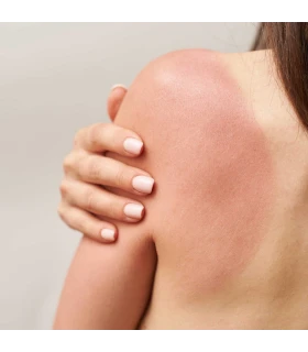 Loción reparadora Cicalmatri piel sensible y radioterapia